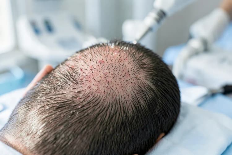 Close-up de um couro cabeludo com folículos capilares sendo transplantados.