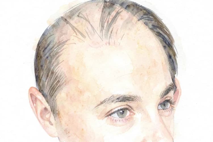 Cabeça de homem com linha de cabelo marcada e entradas visíveis