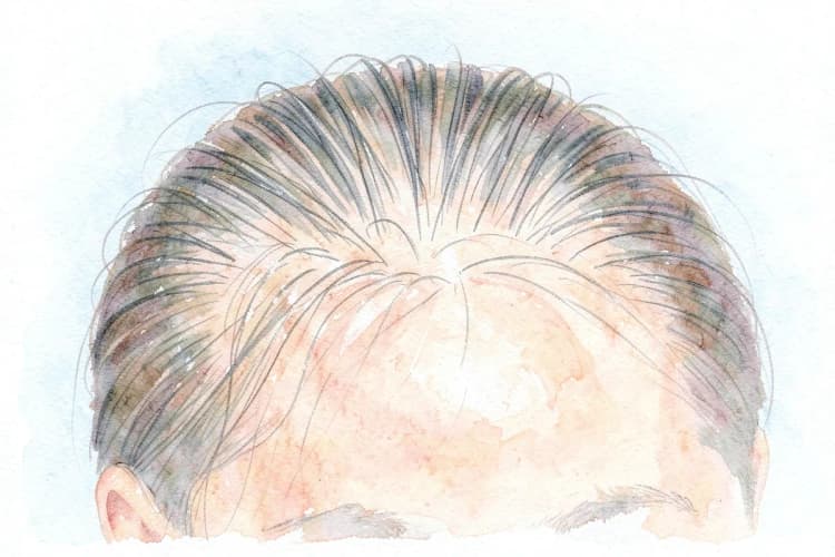 Close-up de um couro cabeludo com finos fios de cabelo recém-implantados.