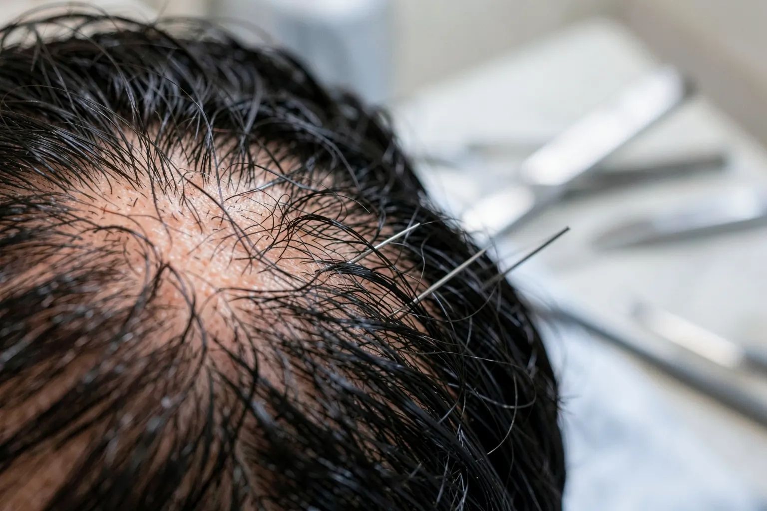 Um close-up de fios de cabelo sendo implantados em um couro cabeludo, com instrumentos cirúrgicos desfocados ao fundo.